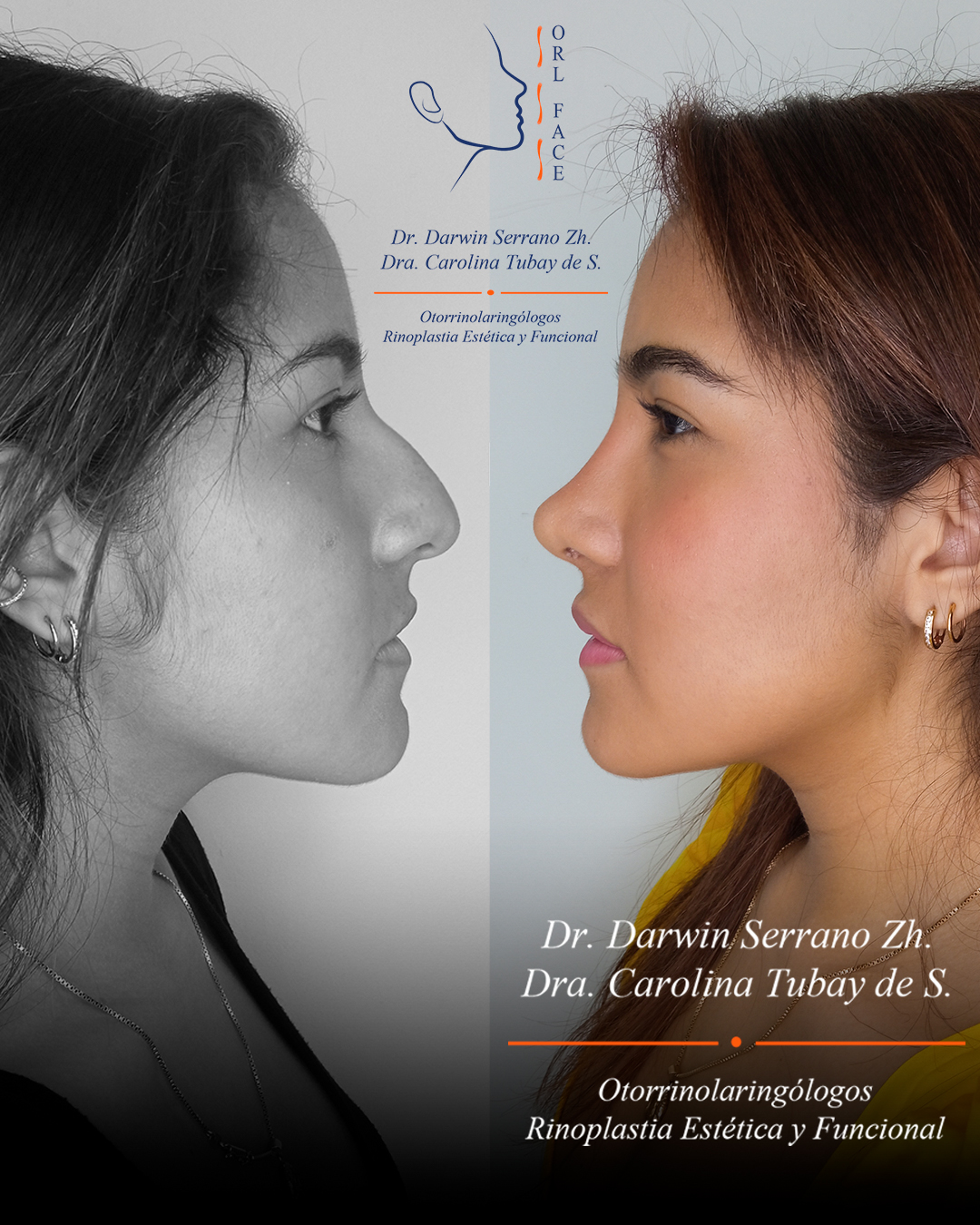 Dr. Darwin Serrano Zh. Dra. Carolina Tubay de S. Otorrinolagingologo, Otorrino. orlface. Manta. Salinas. Rinoplastia.