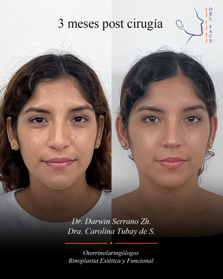 Dr. Darwin Serrano Zh. Dra. Carolina Tubay de S. Otorrinolagingologo, Otorrino. orlface. Manta. Salinas. Rinoplastia.