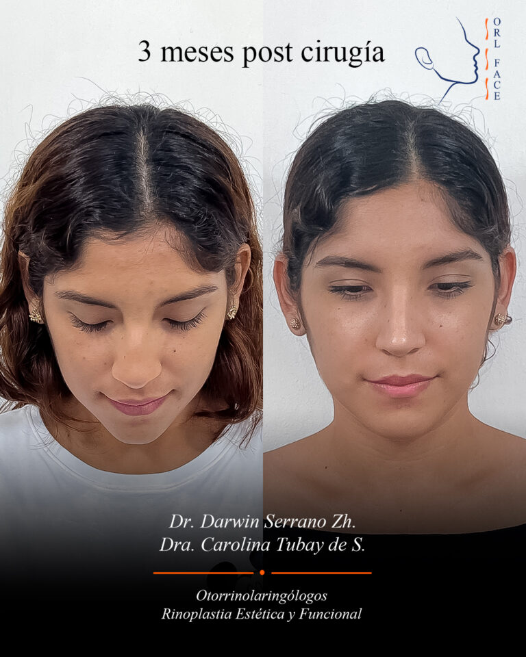 Dr. Darwin Serrano Zh. Dra. Carolina Tubay de S. Otorrinolagingologo, Otorrino. orlface. Manta. Salinas. Rinoplastia.