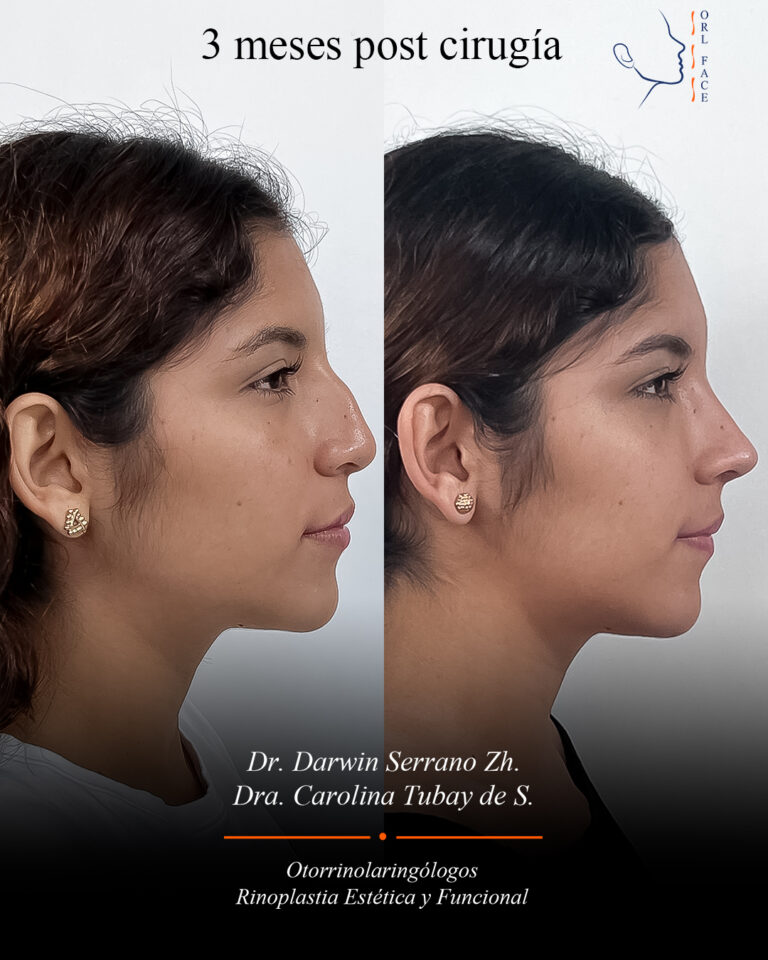 Dr. Darwin Serrano Zh. Dra. Carolina Tubay de S. Otorrinolagingologo, Otorrino. orlface. Manta. Salinas. Rinoplastia.