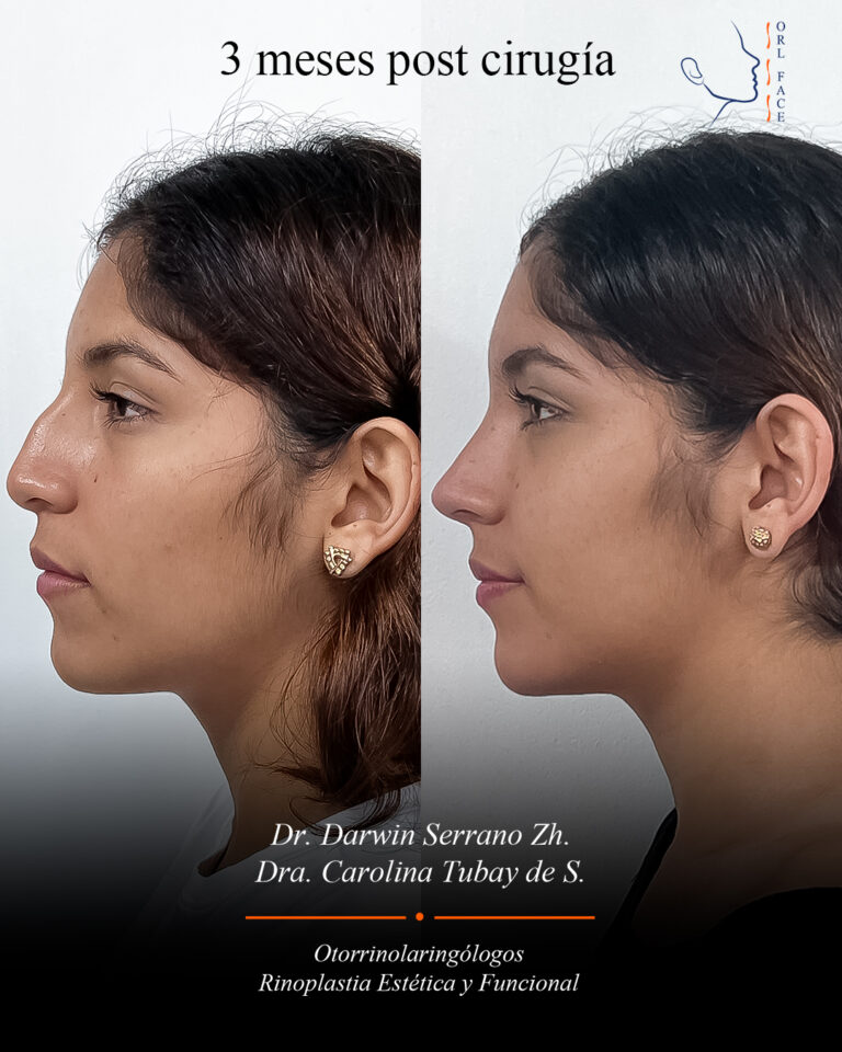 Dr. Darwin Serrano Zh. Dra. Carolina Tubay de S. Otorrinolagingologo, Otorrino. orlface. Manta. Salinas. Rinoplastia.