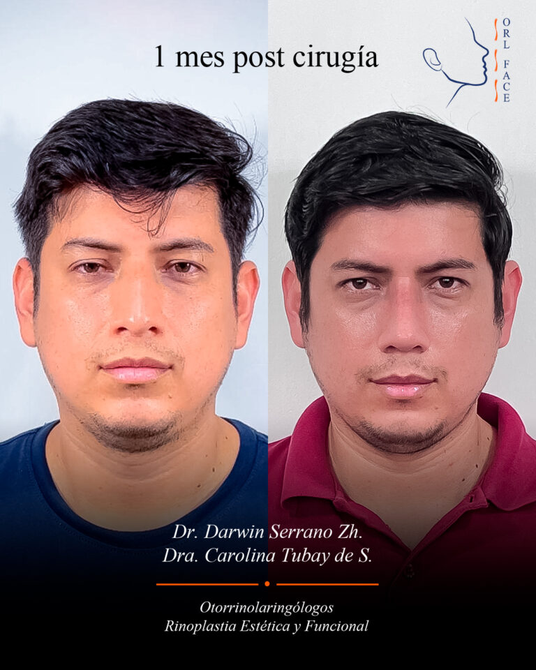 Dr. Darwin Serrano Zh. Dra. Carolina Tubay de S. Otorrinolagingologo, Otorrino. orlface. Manta. Salinas. Rinoplastia.