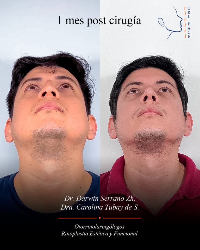Dr. Darwin Serrano Zh. Dra. Carolina Tubay de S. Otorrinolagingologo, Otorrino. orlface. Manta. Salinas. Rinoplastia.