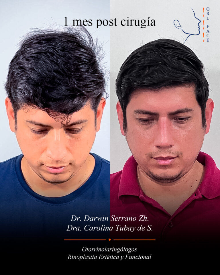 Dr. Darwin Serrano Zh. Dra. Carolina Tubay de S. Otorrinolagingologo, Otorrino. orlface. Manta. Salinas. Rinoplastia.